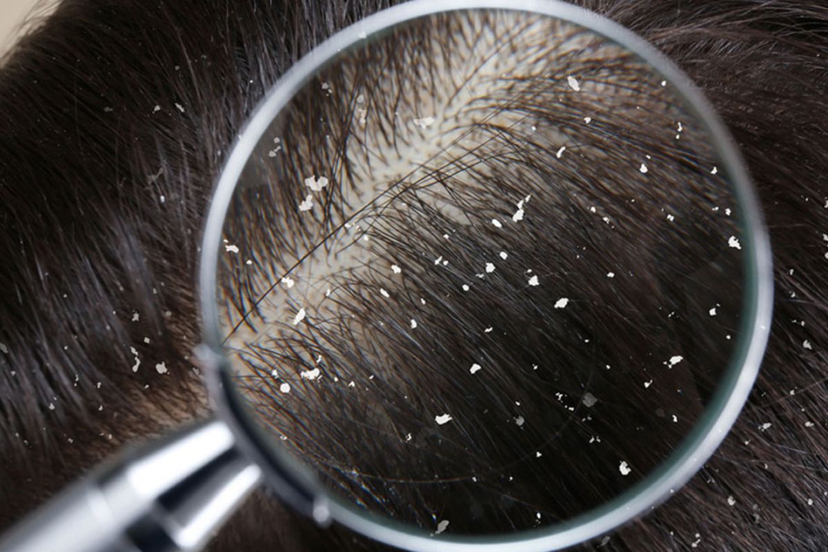 জেনে নিন খুশকি দূর করতে মেথির ব্যবহার