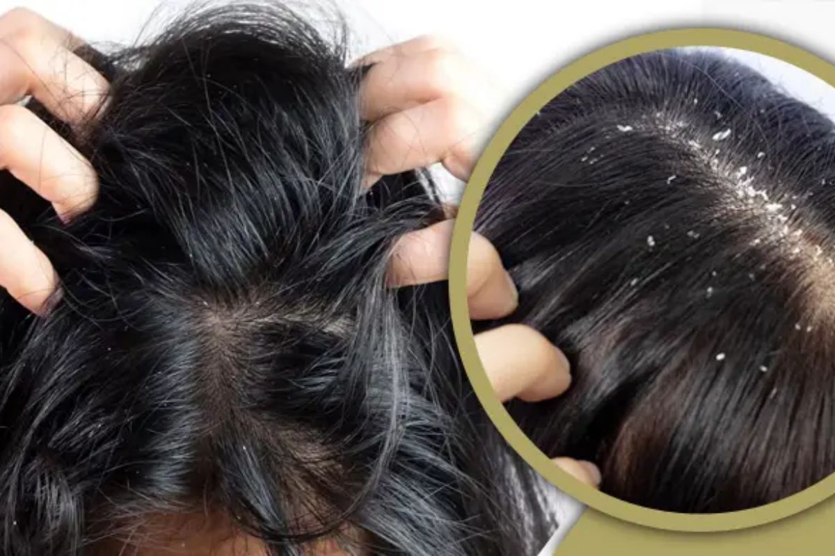 শীতকালে মাথায় খুশকি-চুল পড়া যে ভিটামিনের অভাবে-প্রতিকার