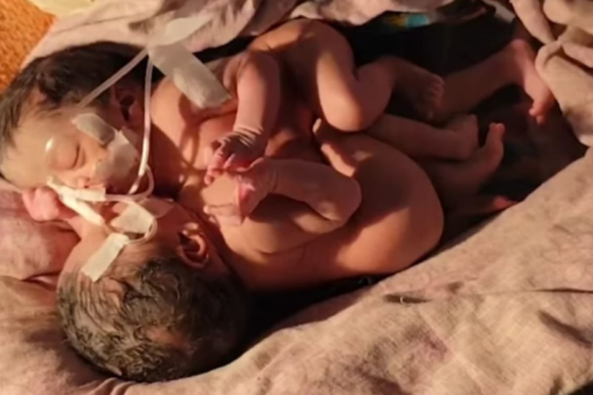 জোড়া লাগানো যমজ শিশুর জন্ম, এলাকাবাসীর উদ্বেগ-কৌতূহল