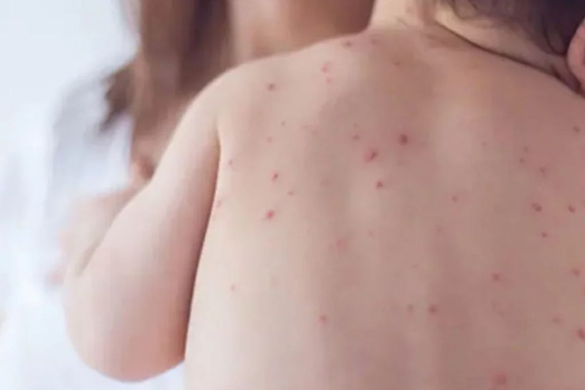 ২৪ ঘণ্টায় হাম ও হামের উপসর্গে ৯ শিশুর মৃ'ত্যু