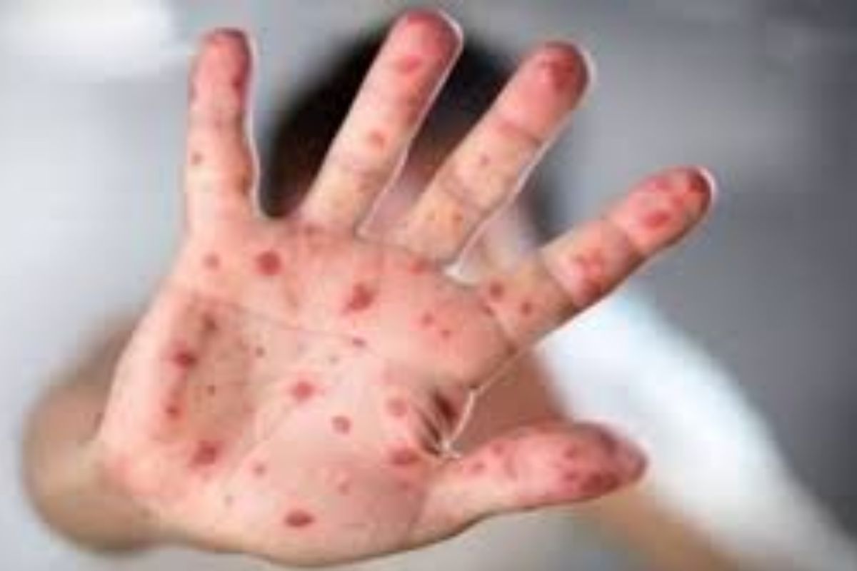 ২৪ ঘণ্টায় হামের উপসর্গ নিয়ে আরও ৪ শিশুর মৃ'ত্যু