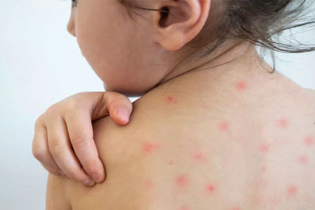 ২৪ ঘণ্টায় হামের উপসর্গ নিয়ে আরও ৪ শিশুর মৃ'ত্যু