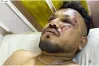 ভারতের বিমান বিধ্বস্তে বেঁচে গেলেন এক যুবক