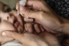 অর্থ সংকটে পোলিও নির্মূল কার্যক্রম ঝুঁকিতে
