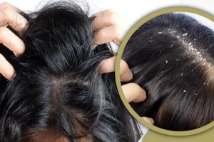 শীতকালে মাথায় খুশকি-চুল পড়া যে ভিটামিনের অভাবে-প্রতিকার