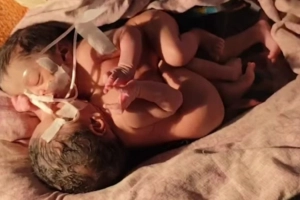 জোড়া লাগানো যমজ শিশুর জন্ম, এলাকাবাসীর উদ্বেগ-কৌতূহল