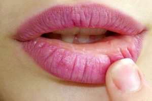 শীতে কেন ফাটে ঠোঁট? জেনে নিন বাঁচার উপায়