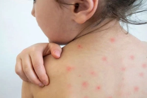 হামের ঝুঁকি থেকে শিশুকে রক্ষার উপায়