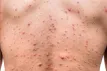 হাম আক্রান্তে আরও ৯ শিশুর মৃ’ত্যু