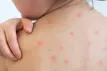 চট্টগ্রামে আরও ১৬ শিশুর হাম শনাক্ত